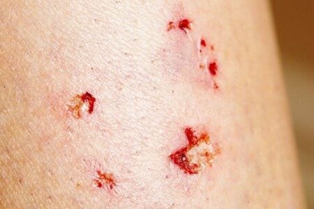 Bị chó cắn xước nhẹ ở chân có sao không​? Cách xử lý