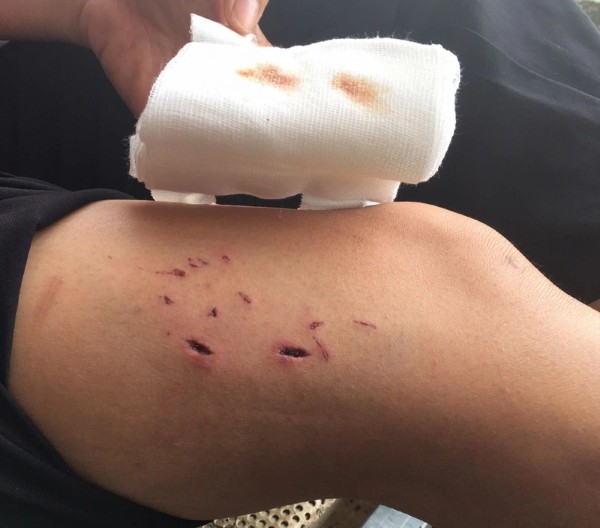 Phòng ngừa các biến chứng sau khi bị chó cắn